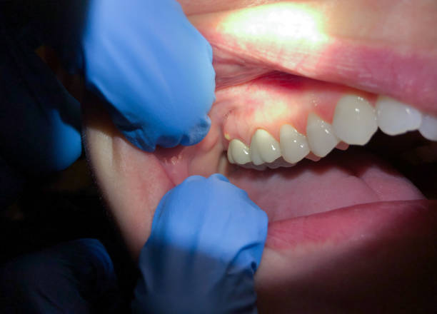 Best Emergency Broken Tooth Repair in Southworth, WA